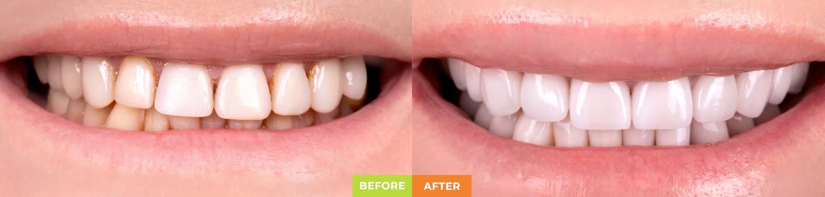 before-after-placer-sm-side-1