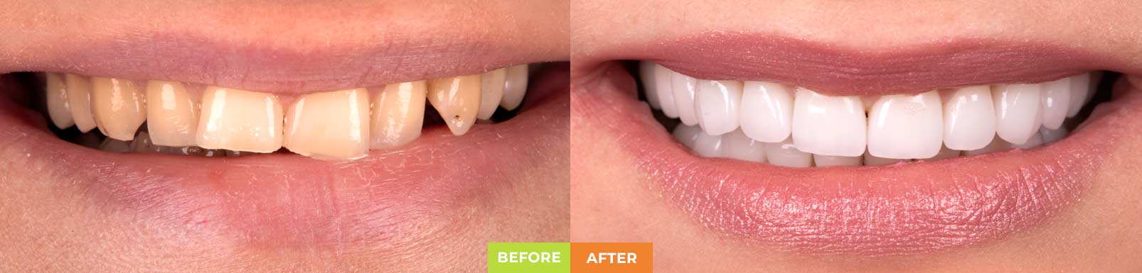 before-after-placer-sm-side-2