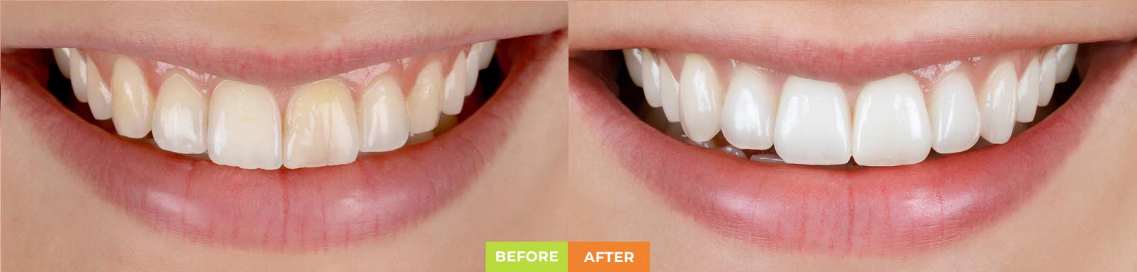 before-after-placer-sm-side-3